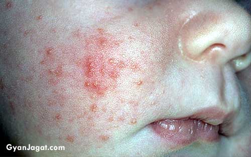 Ghamori Prickly Heat Treatment Home Remedies in Hindi