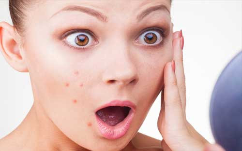 Know Reason of Pimples in Hindi