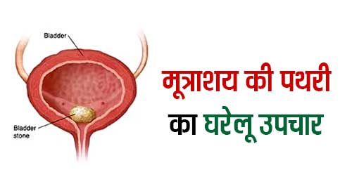 Bladder Stone Home Remedies in Hindi
