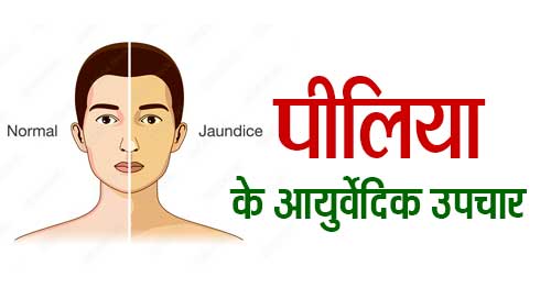 jaundice ayurvedic treatment in hindi